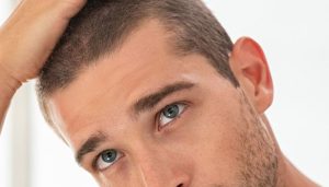 Read more about the article Scalp Micropigmentation: How It’s Done and Expected Results