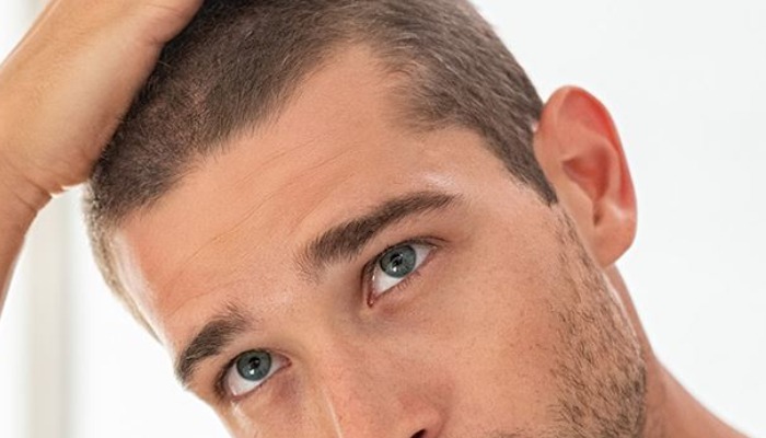 You are currently viewing Scalp Micropigmentation: How It’s Done and Expected Results