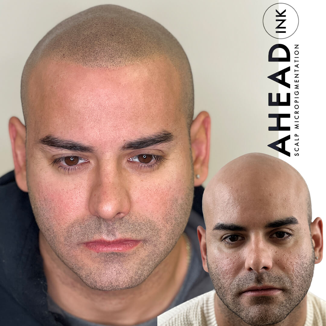 You are currently viewing <strong>SMP Aftercare Tips: What To Do After Your First Scalp Micropigmentation Session</strong>