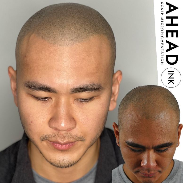 You are currently viewing Get a Permanent Hairline Restoration Solution with Scalp Micropigmentation at Ahead Ink