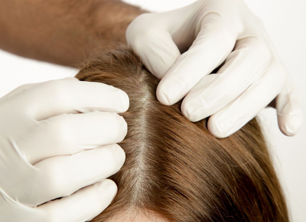 You are currently viewing Scalp Micropigmentation for Women: Can Women Have SMP?
