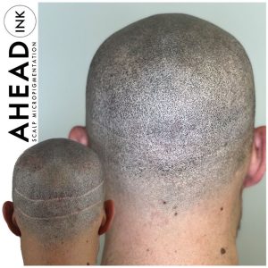 Read more about the article Hide Your Hair Transplant Scars with Scalp Micropigmentation (SMP)