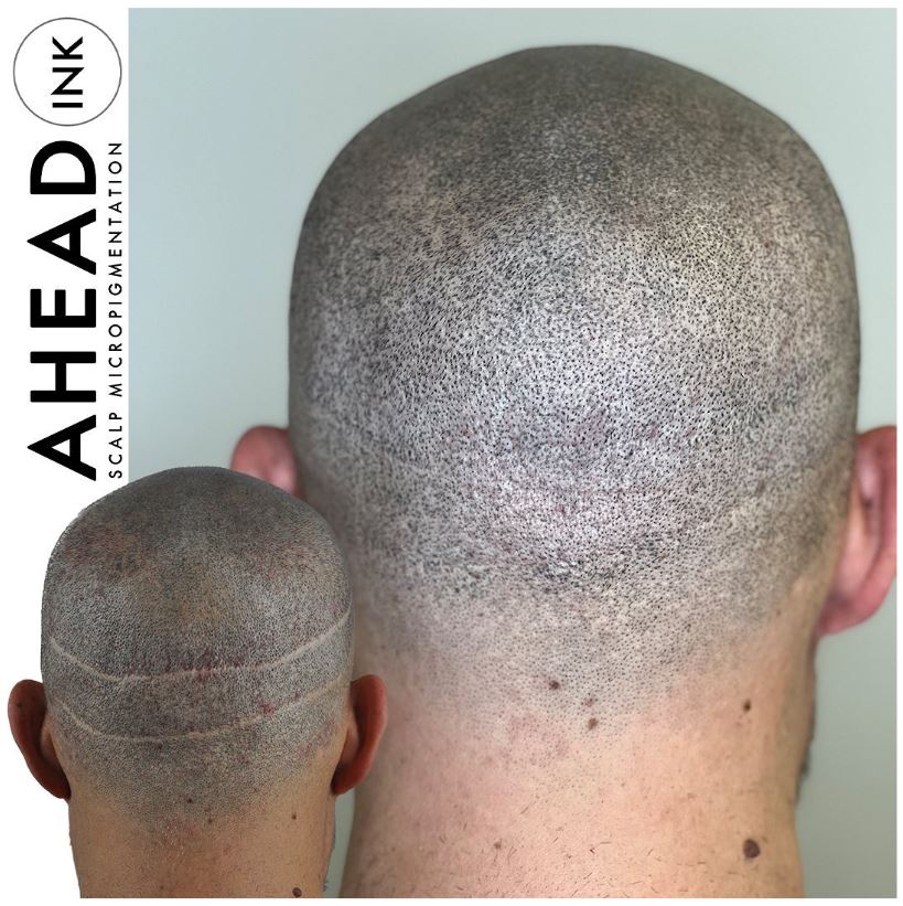 You are currently viewing Hide Your Hair Transplant Scars with Scalp Micropigmentation (SMP)
