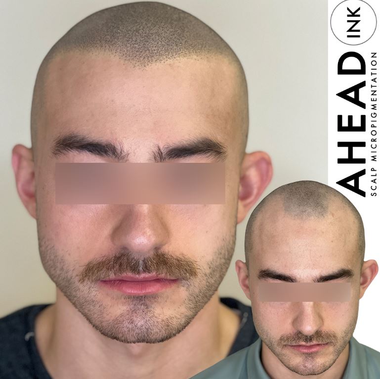 You are currently viewing SMP Treatments at Ahead Ink – Best Scalp Micropigmentation New York & New Jersey