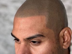 Read more about the article How Much Does Scalp Micropigmentation Cost in New Jersey? 