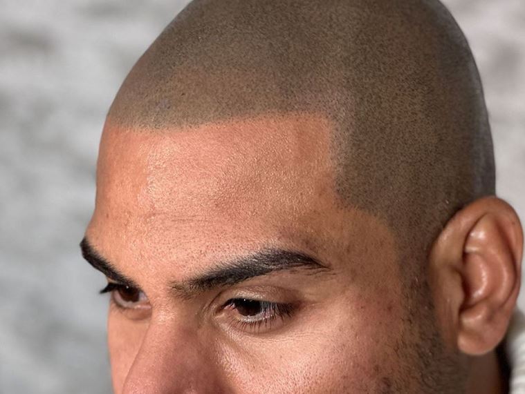 You are currently viewing How Much Does Scalp Micropigmentation Cost in New Jersey? 